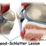 Osgood Shlatter (Eventskarate 11 feb.2009)